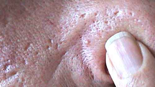 Skin with holes and bumps